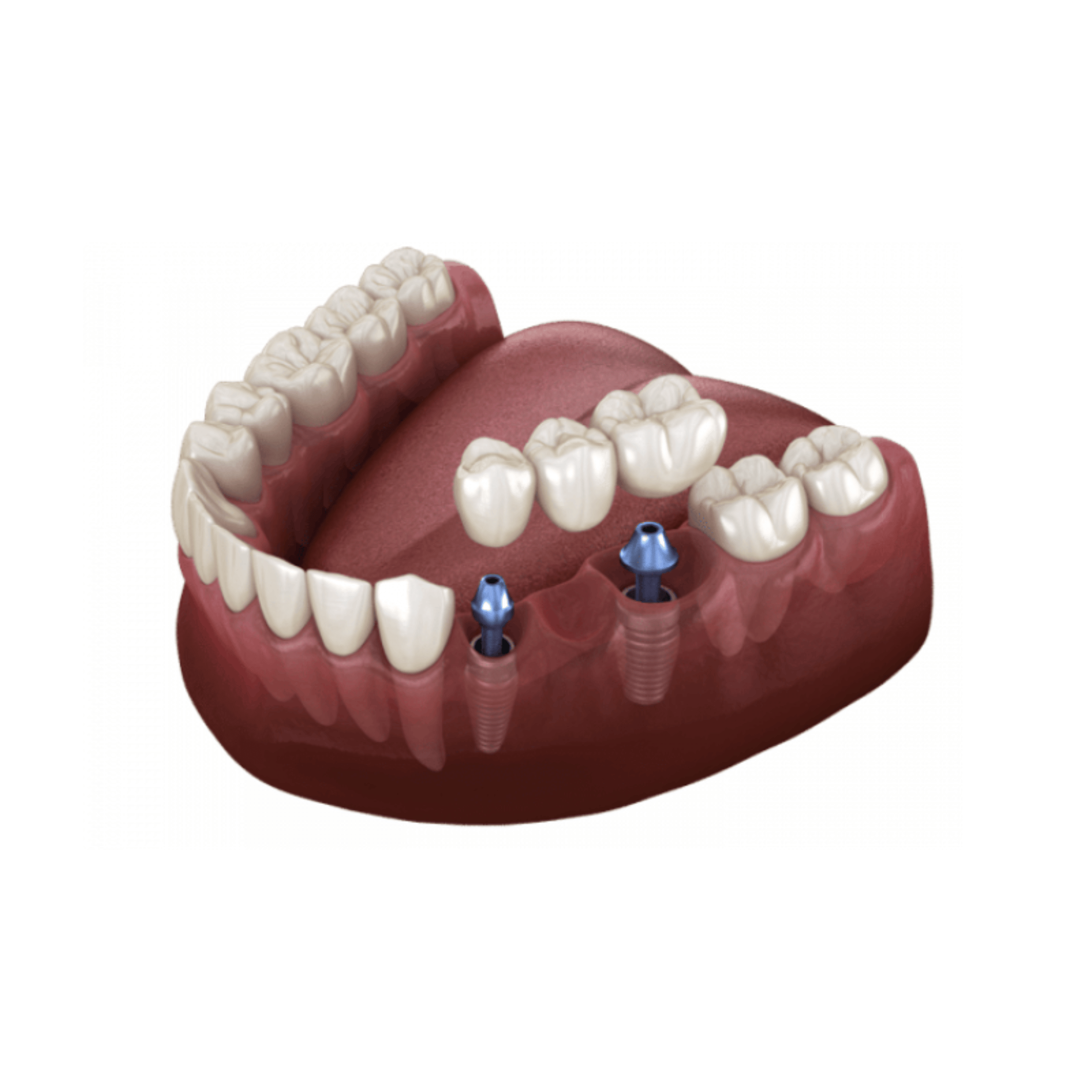 Multi Dental Implants l Dental99