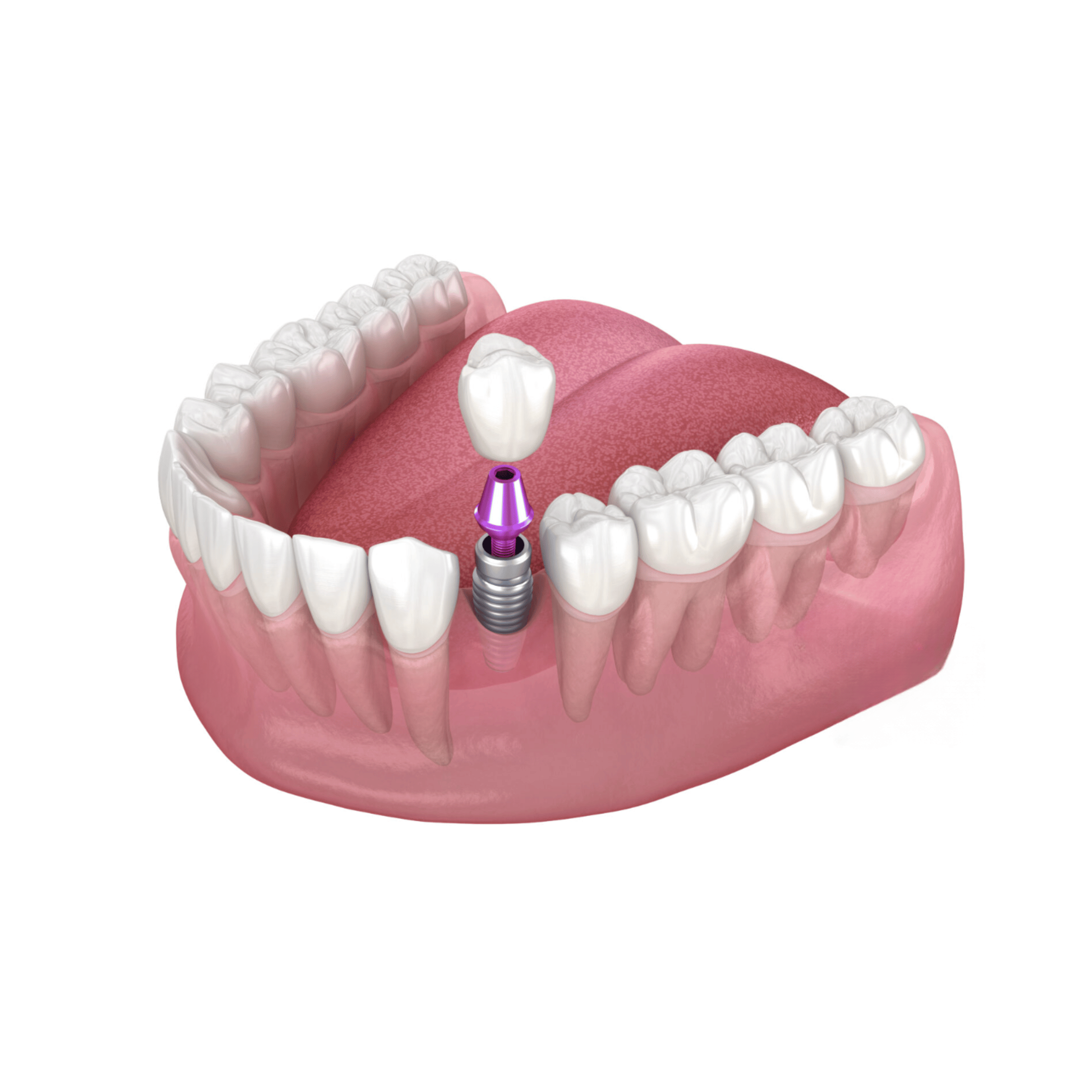 Single Dental Implant l Dental99