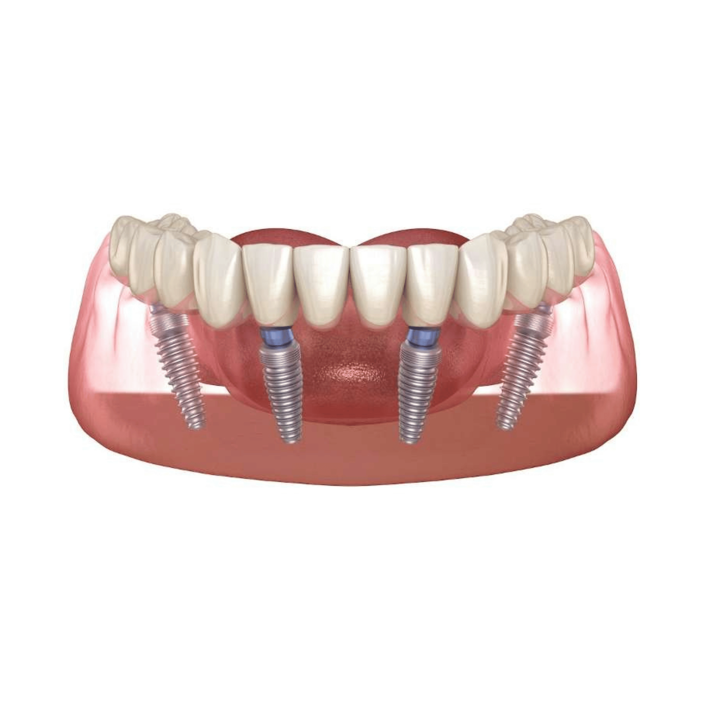 All-On-4 Dental Implants l Dental99