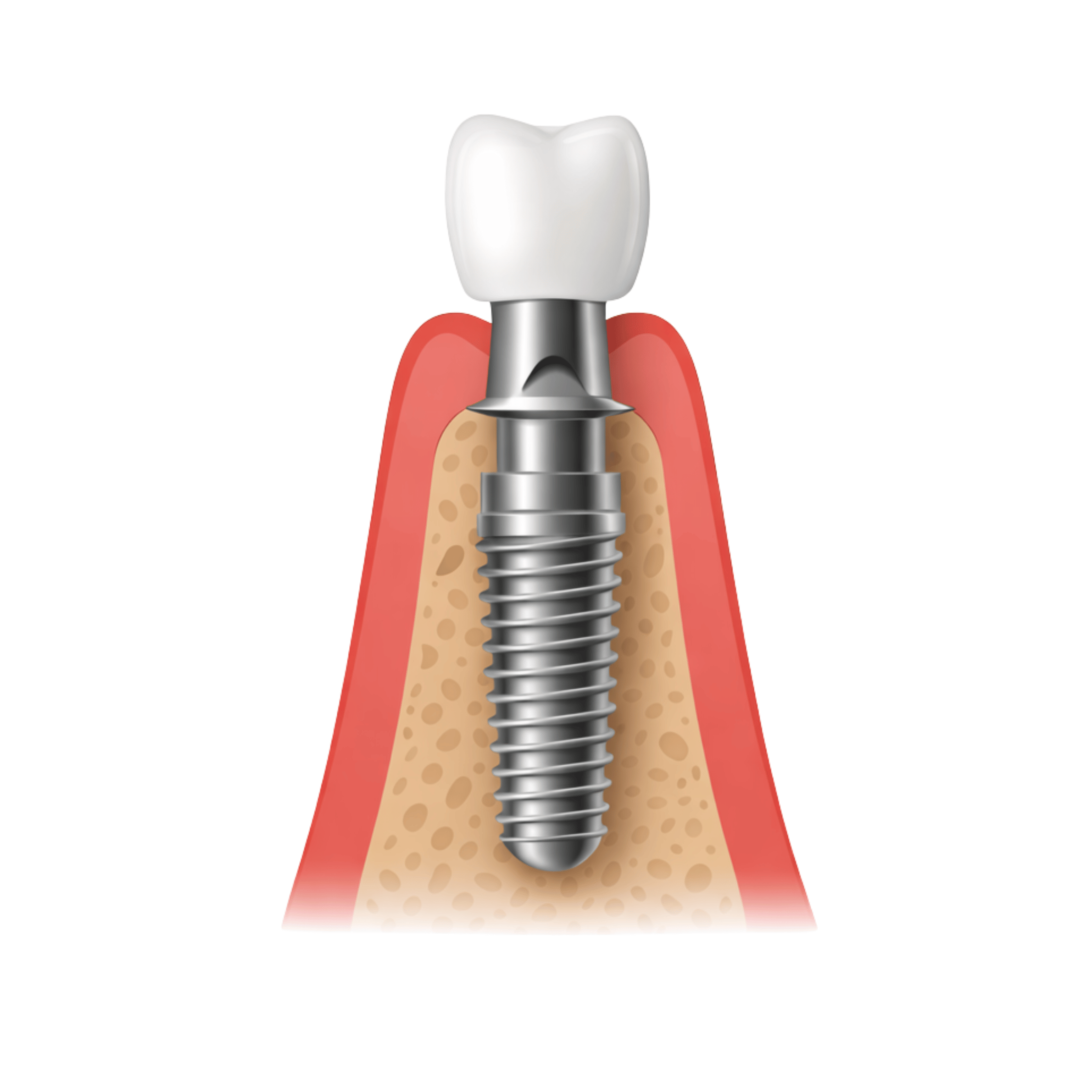 Titanium Dental Implant + Crown-1
