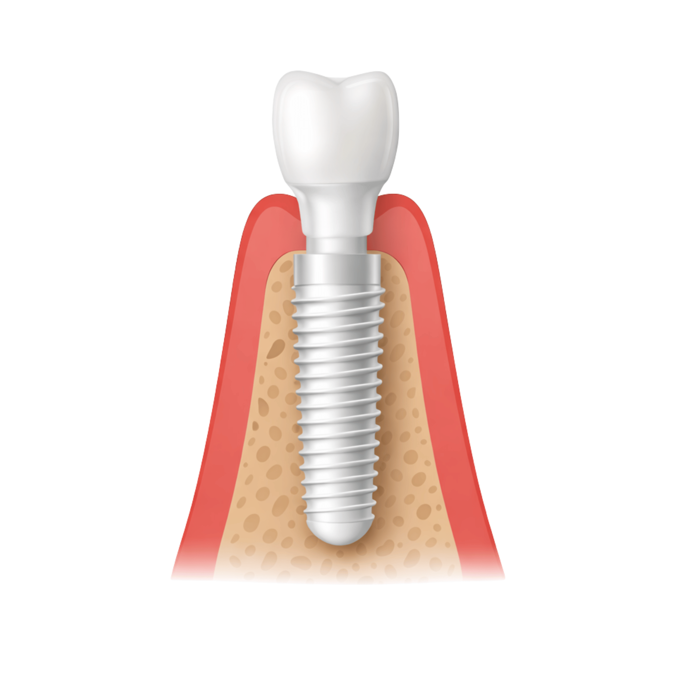 Zirconia Dental Implant + Crown-1