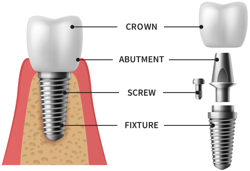 Dental Implant